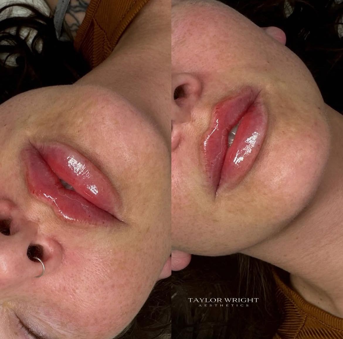 Lip Filler 