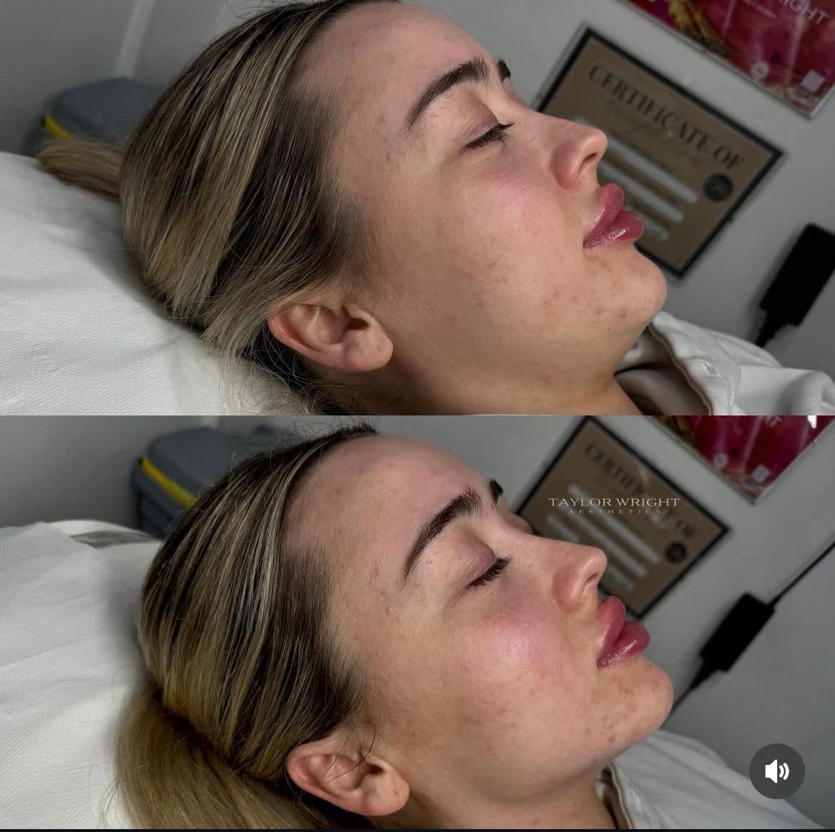 Jaw Filler 