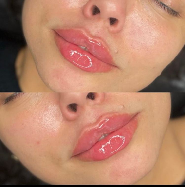 LIP FILLER ENHANCEMENT 