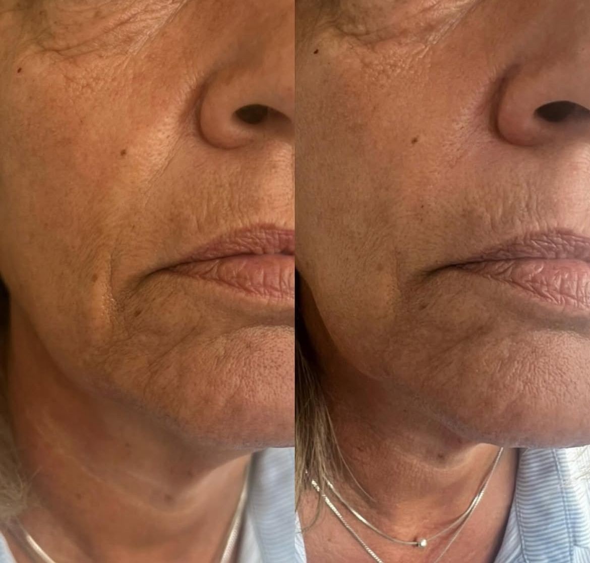 Dermal Filler