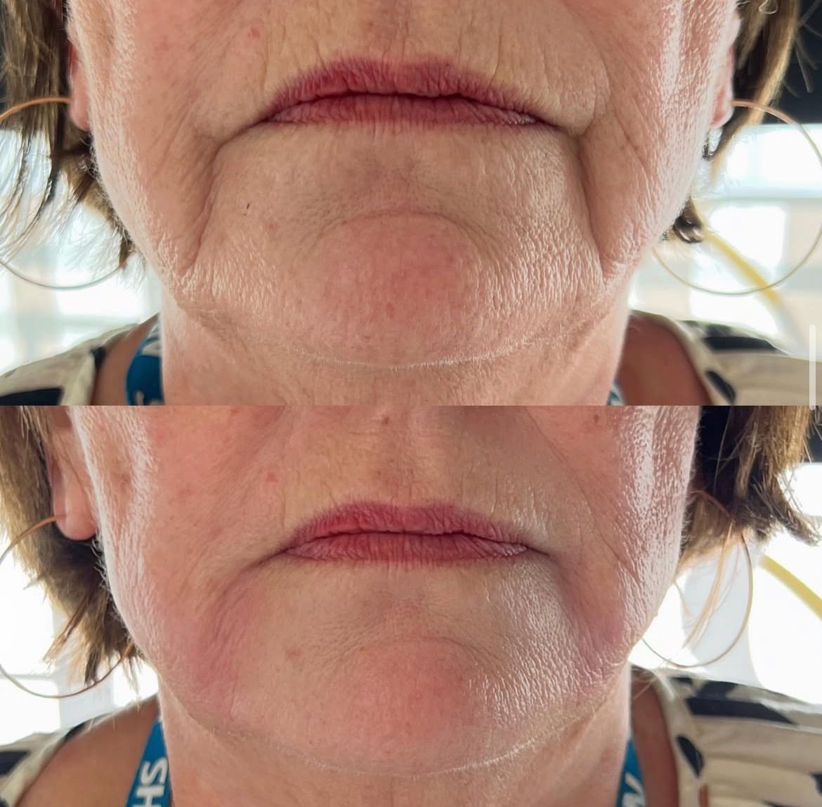 SKIN BOOSTERS 