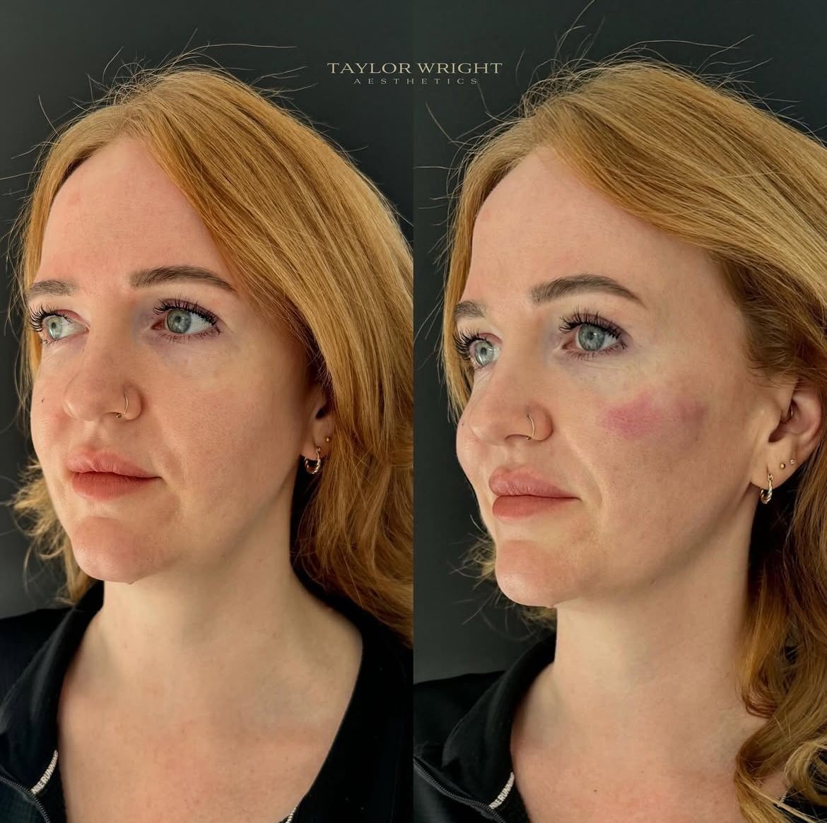Cheek Filler 